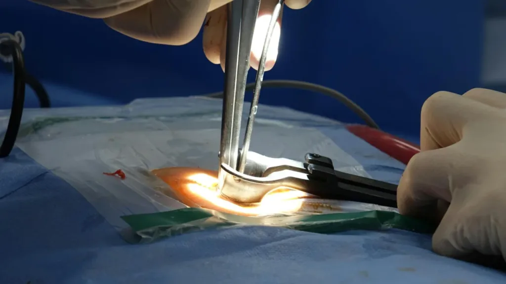 Understanding Hernia Mesh Revision Settlement Options